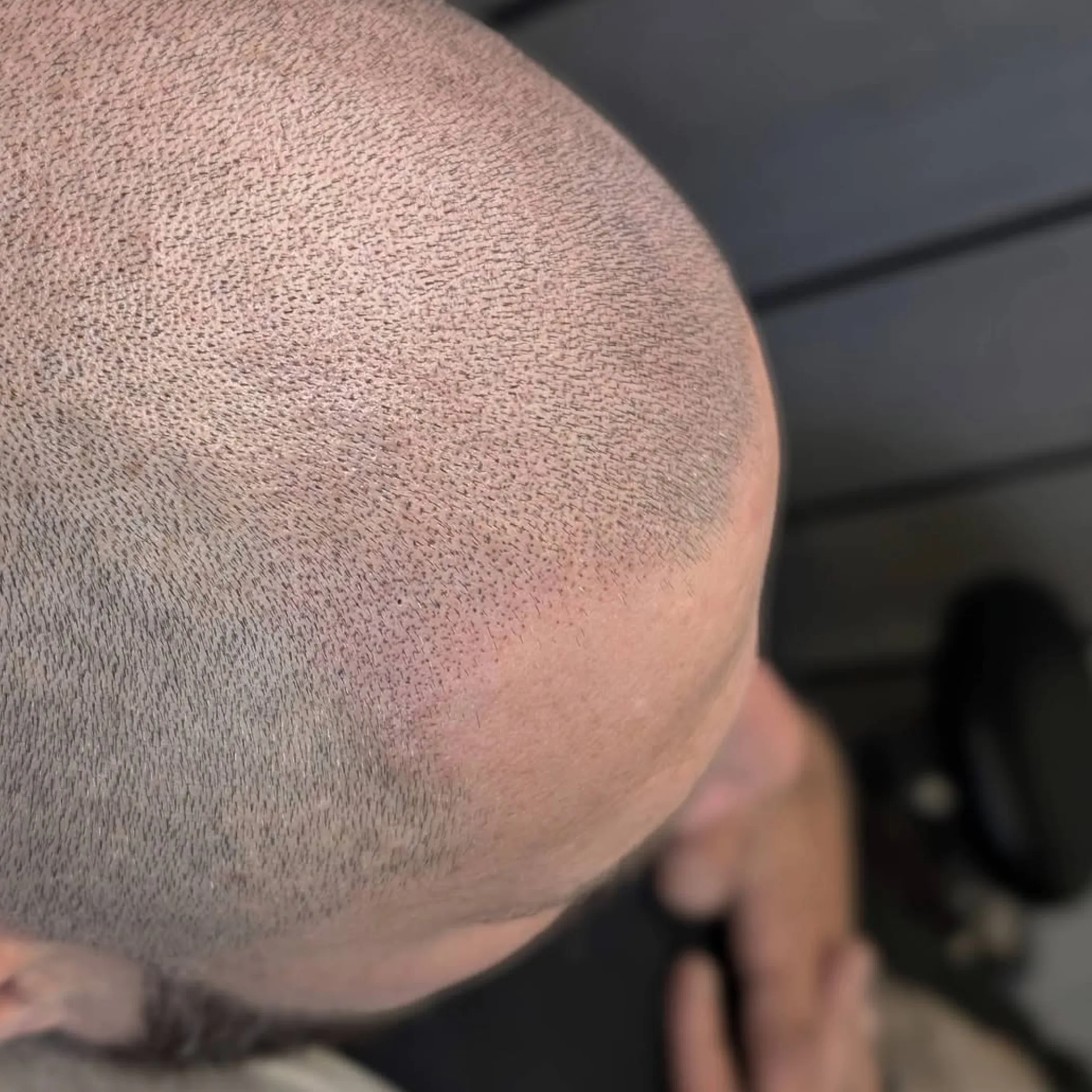 close-up of scalp micropigmentation treatment