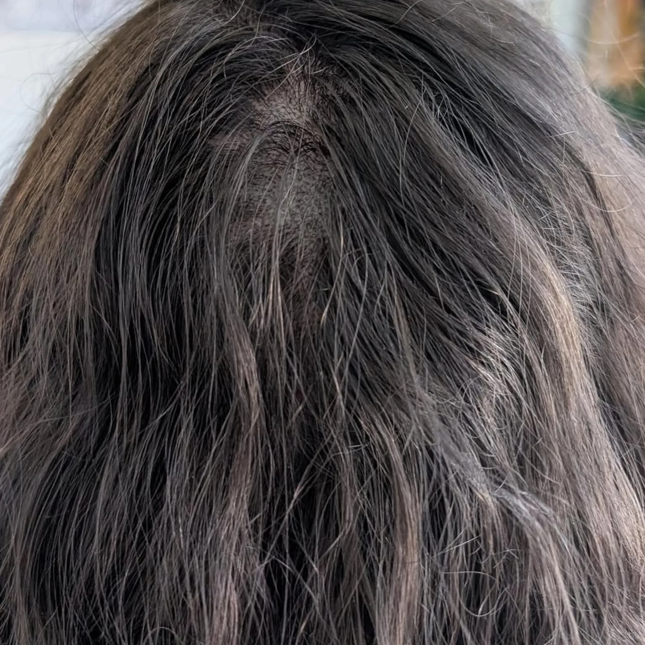 scalp micropigmentation on scalp close-up