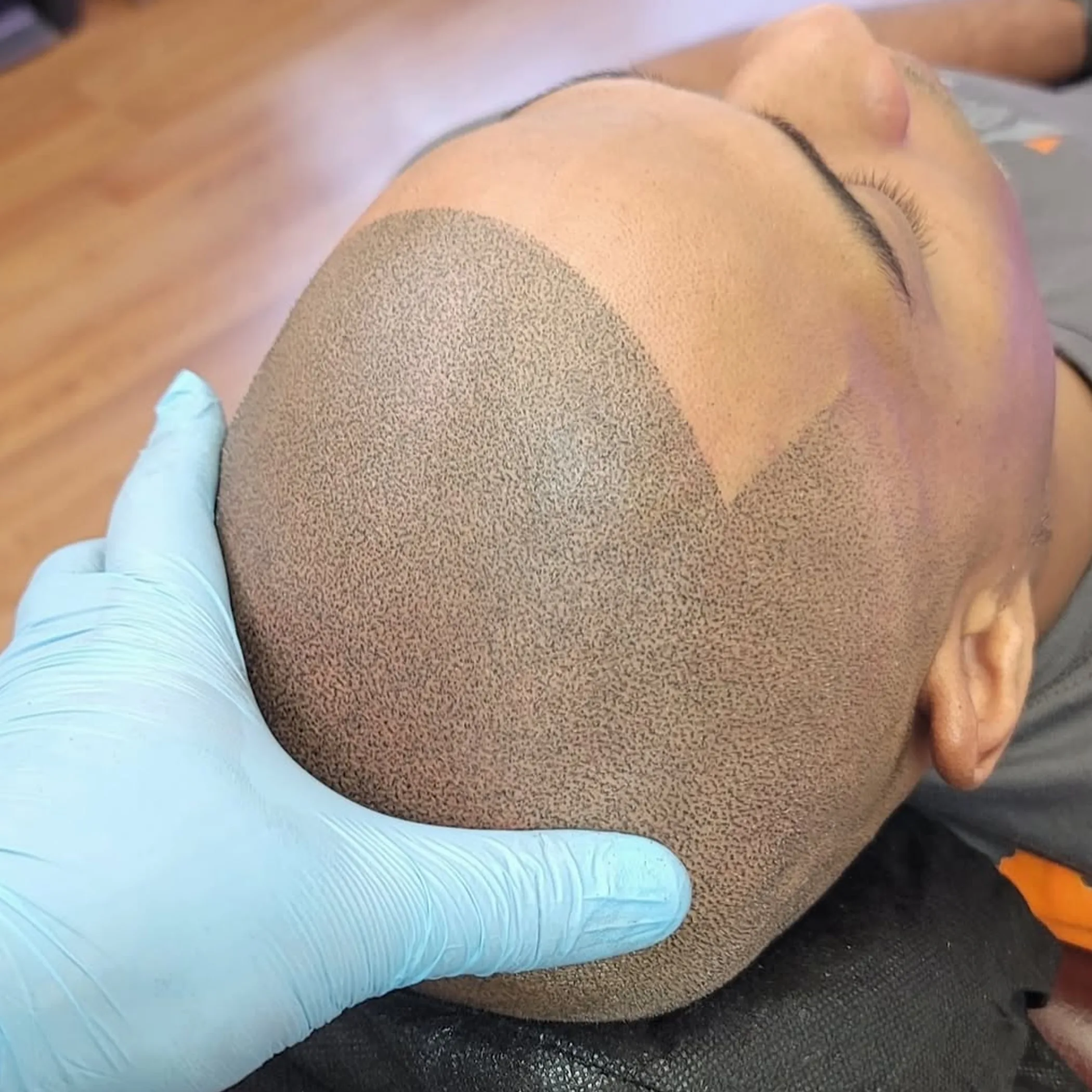 scalp micropigmentation procedure close-up