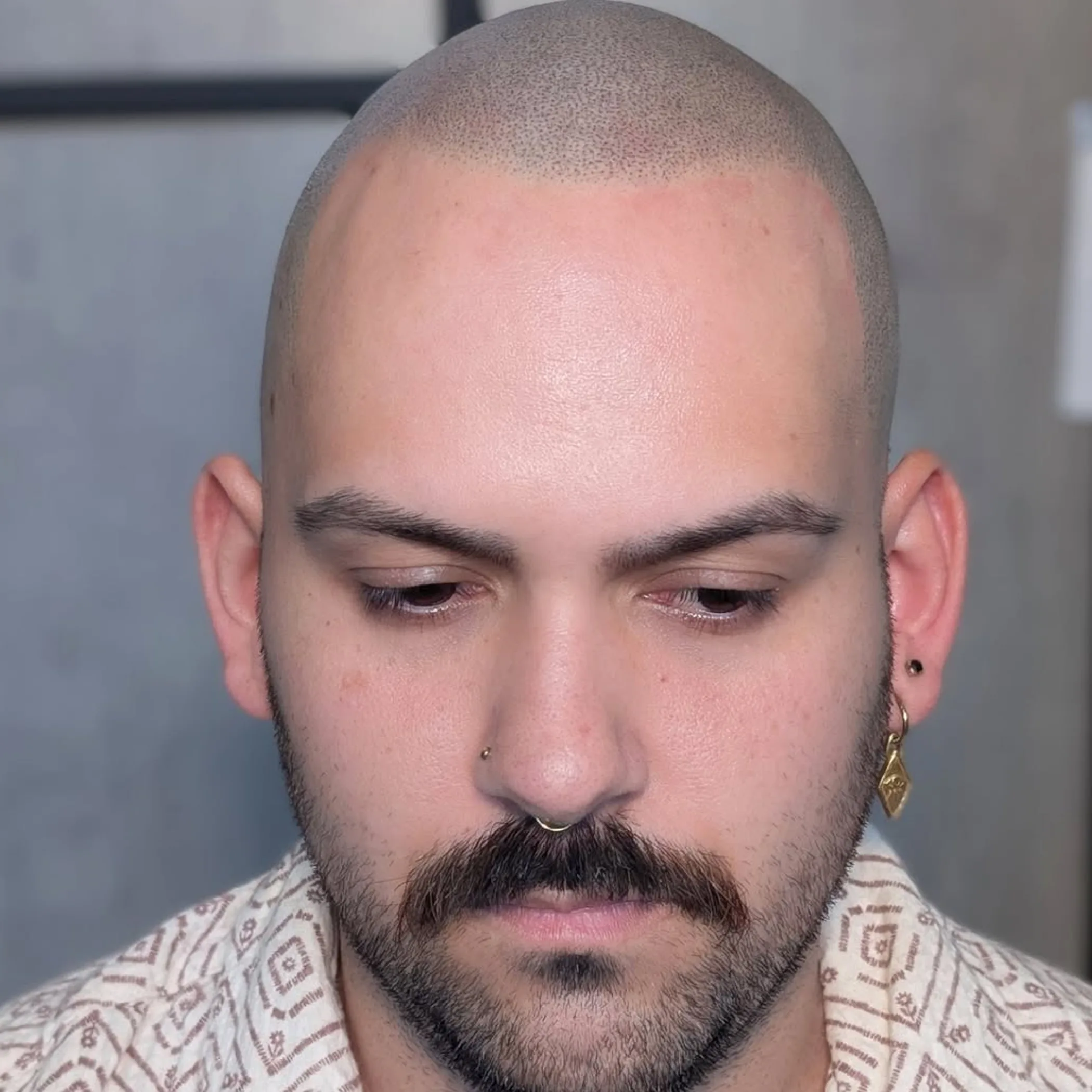 scalp micropigmentation procedure close-up