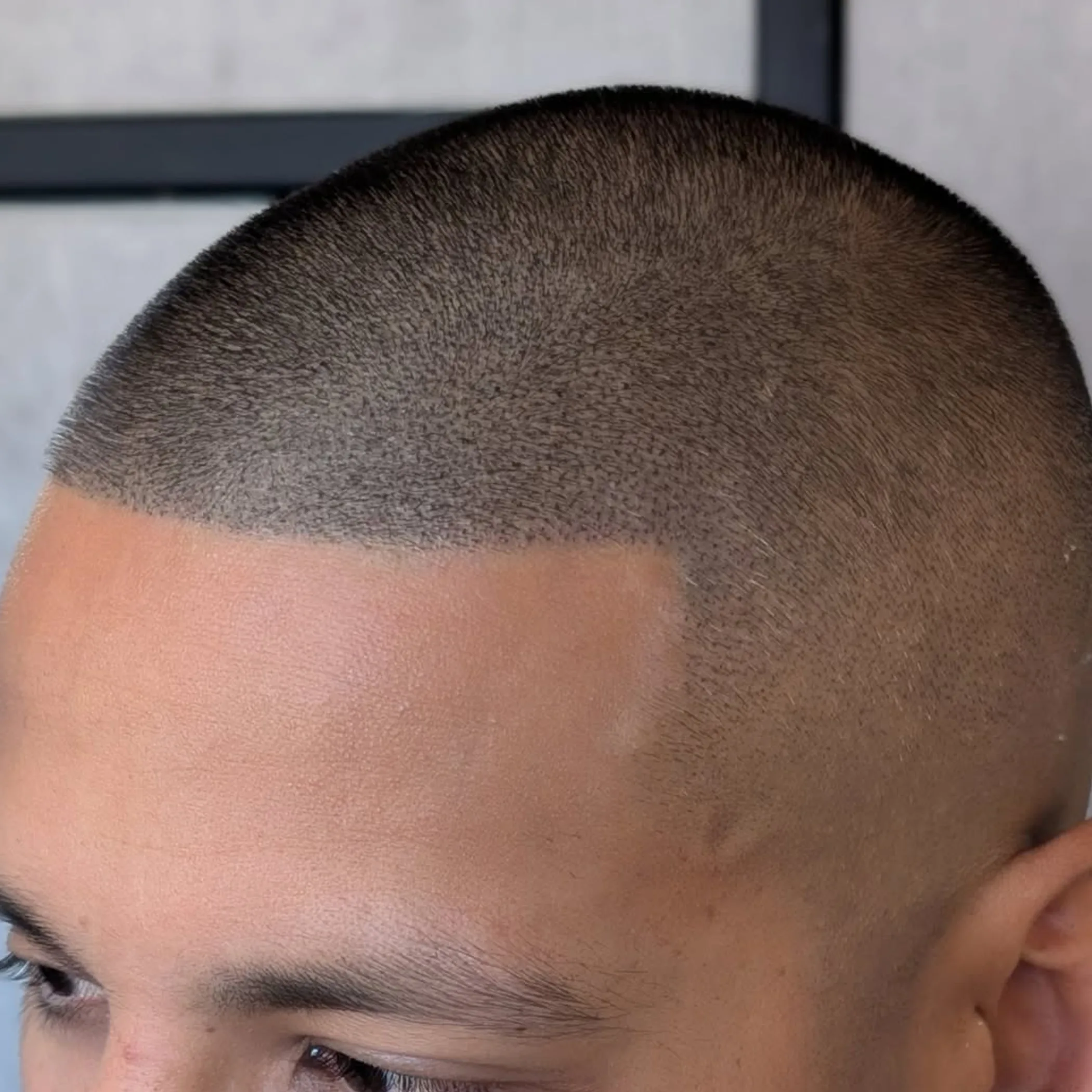 scalp micropigmentation procedure close-up