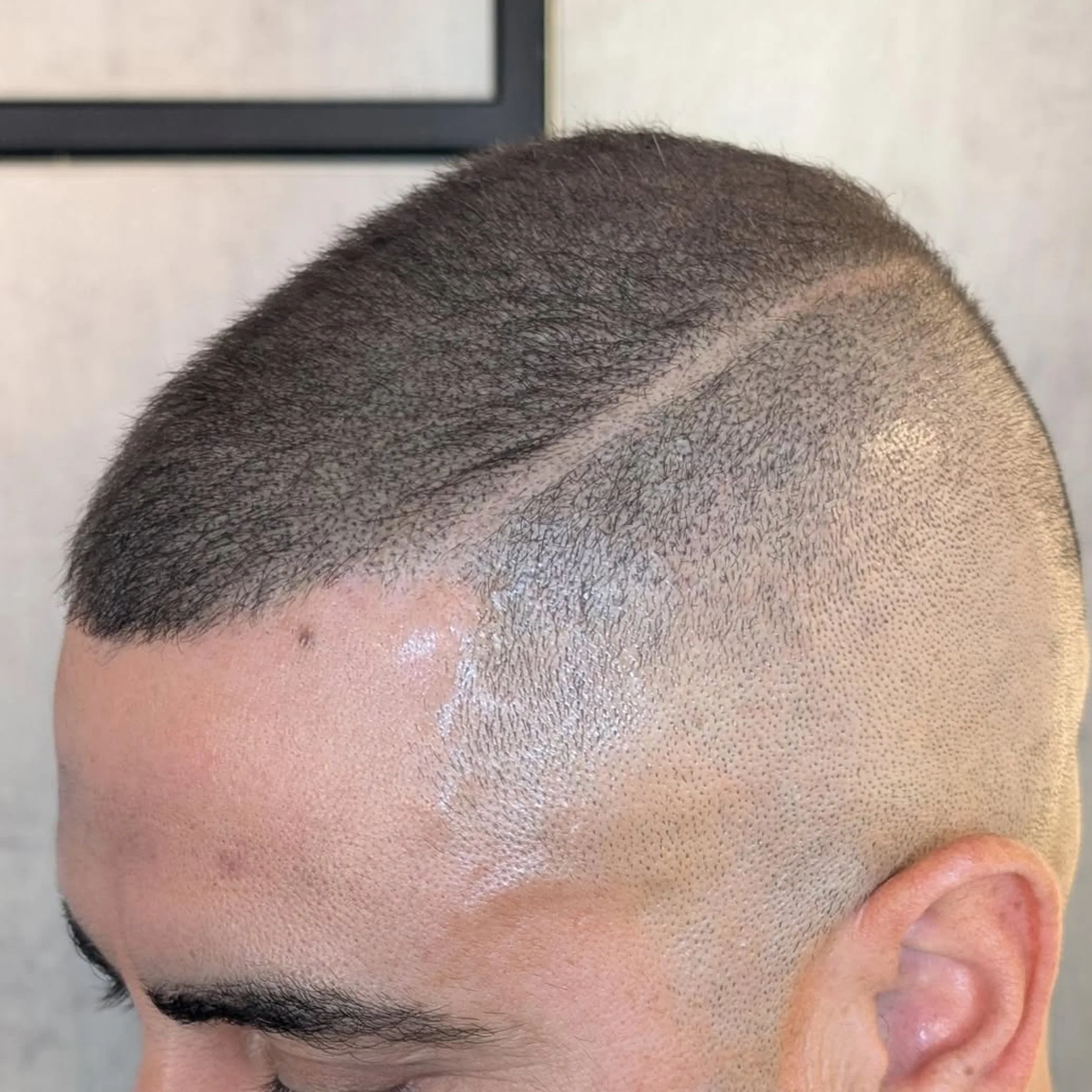 scalp micropigmentation procedure close-up