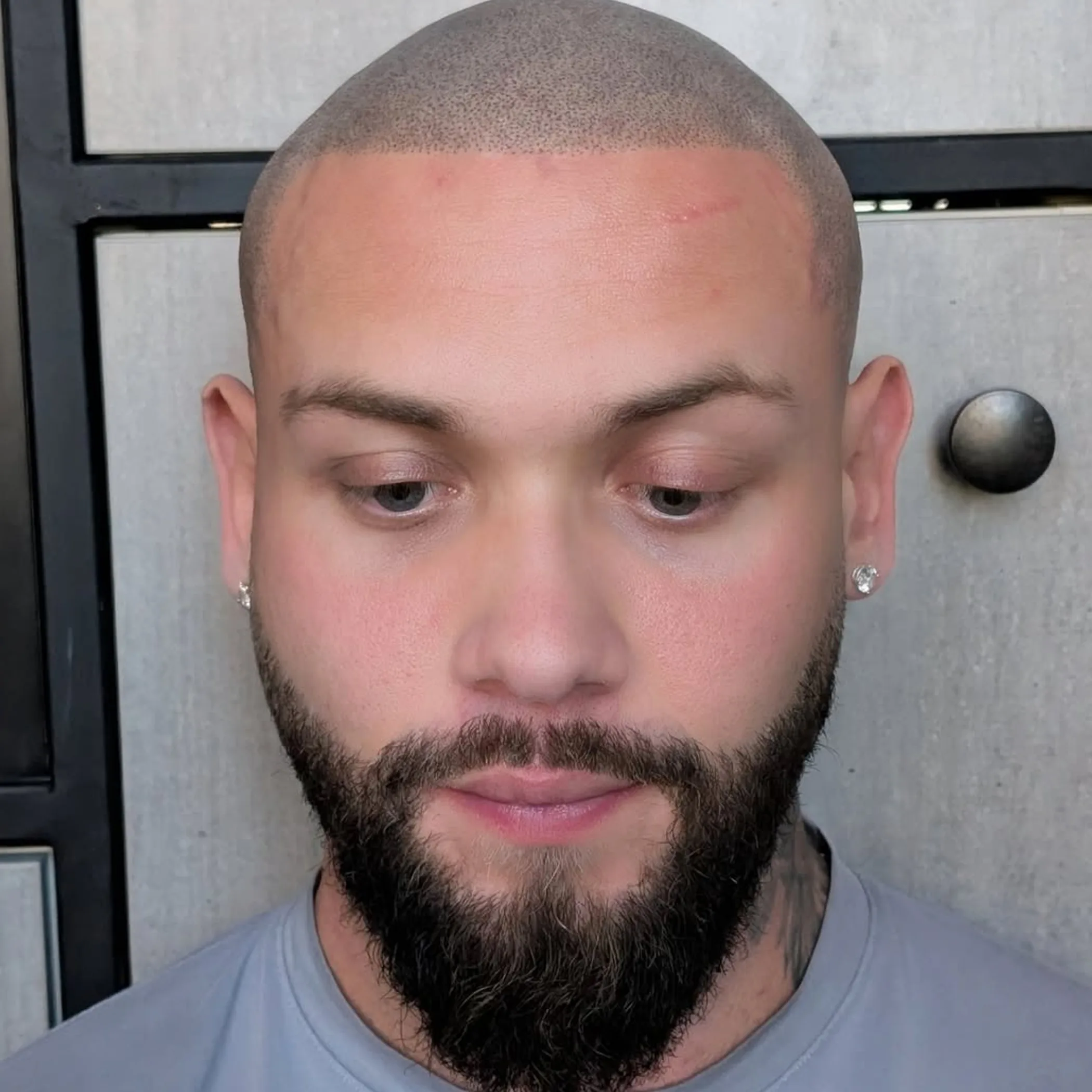 scalp micropigmentation procedure close-up